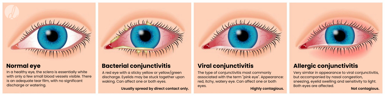 Viral Conjunctivitis Vs Bacterial Conjunctivitis Viral Conjunctivitis Vs Bacterial Conjunctivitis